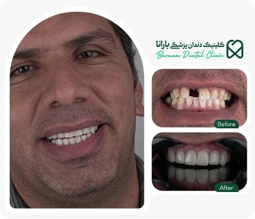 افزایش ماندگاری لمینت دندان